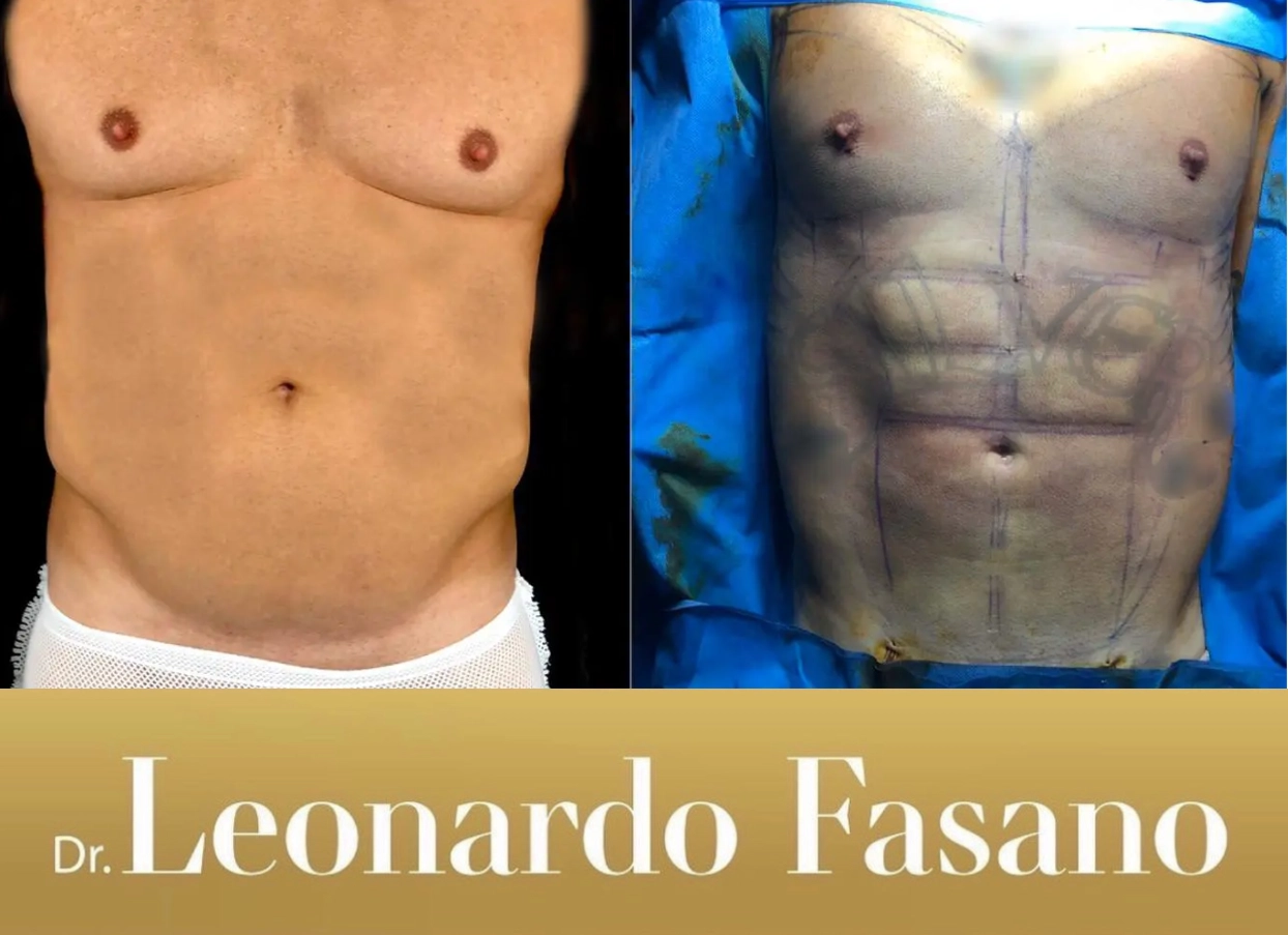 Liposuction with Dr Fasano