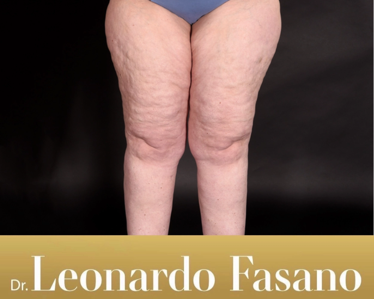 What is Lipoedema?