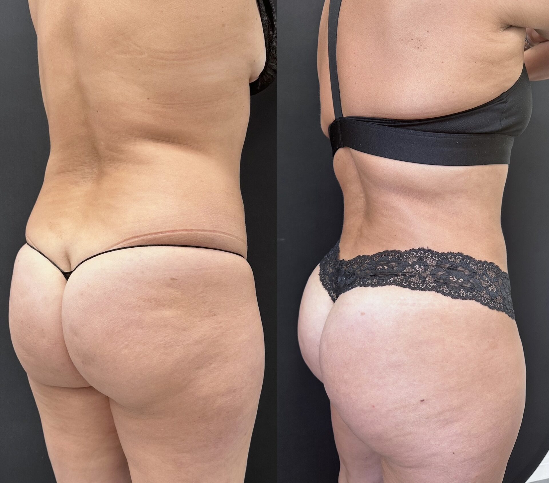 Does Liposuction leave Scars?